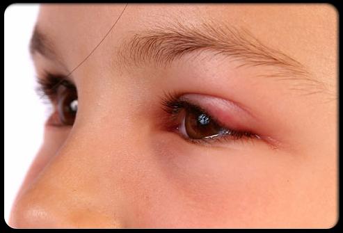 Röda ögonproteiner: orsaker, effekter och metoder för behandling. Varför är de röda ekorren i ett barn eller en vuxen?