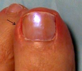 Spiken växte i ett finger: orsakerna och behandlingen